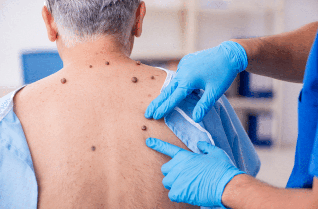 What Is the Most Effective Treatment for Skin Cancer?